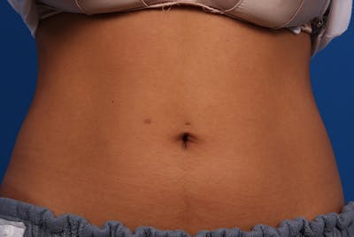 Coolsculpting Before & After Gallery - Patient 12973928 - Image 1