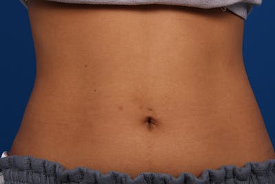 Coolsculpting Before & After Gallery - Patient 12973928 - Image 2