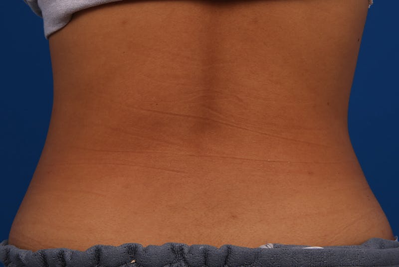 Coolsculpting Before & After Gallery - Patient 12973928 - Image 4