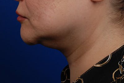 Kybella Before & After Gallery - Patient 12973941 - Image 1