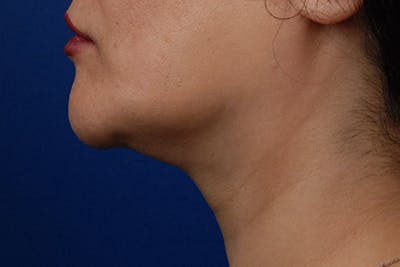 Kybella Before & After Gallery - Patient 12973941 - Image 2