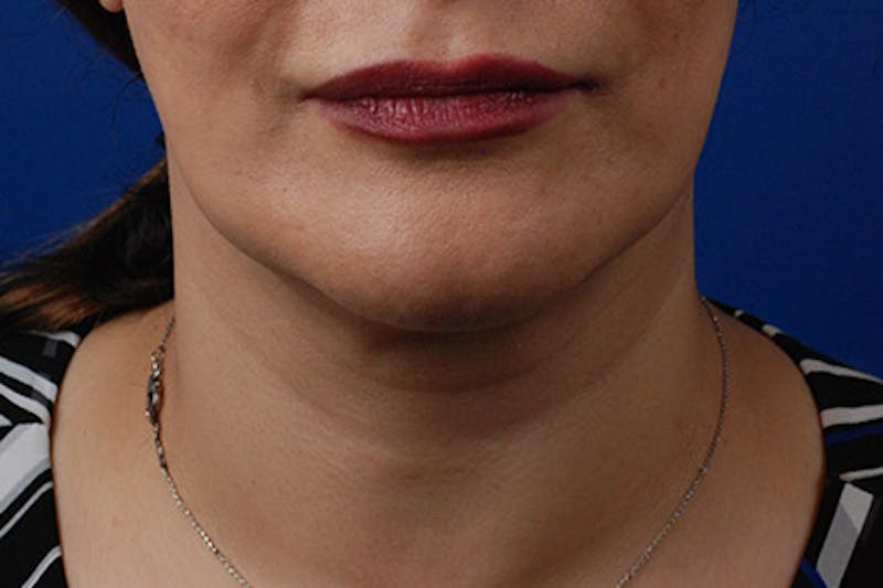 Kybella Before & After Gallery - Patient 12973941 - Image 5
