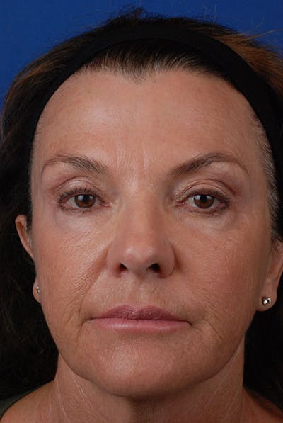 Laser Skin Resurfacing Before & After Gallery - Patient 12973942 - Image 1
