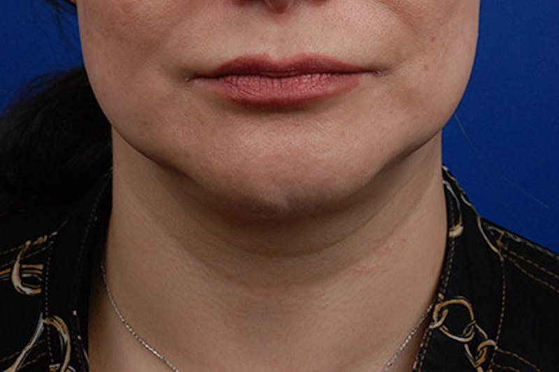 Kybella Before & After Gallery - Patient 12973941 - Image 6