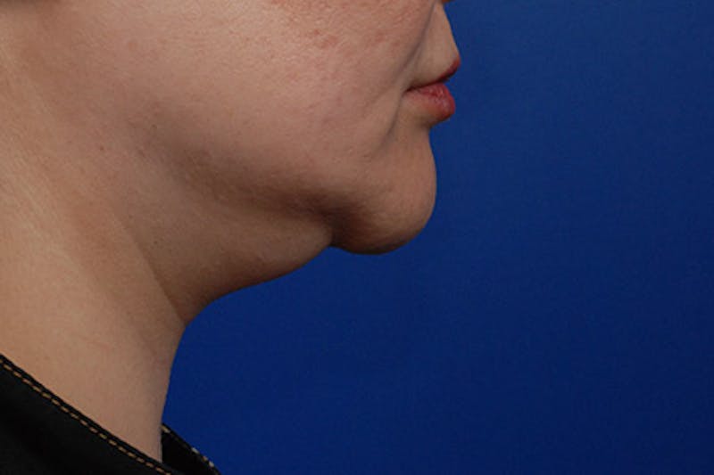 Kybella Before & After Gallery - Patient 12973941 - Image 7
