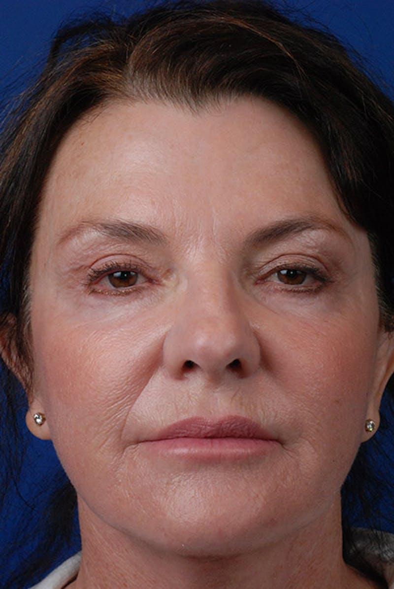 Laser Skin Resurfacing Before & After Gallery - Patient 12973942 - Image 2