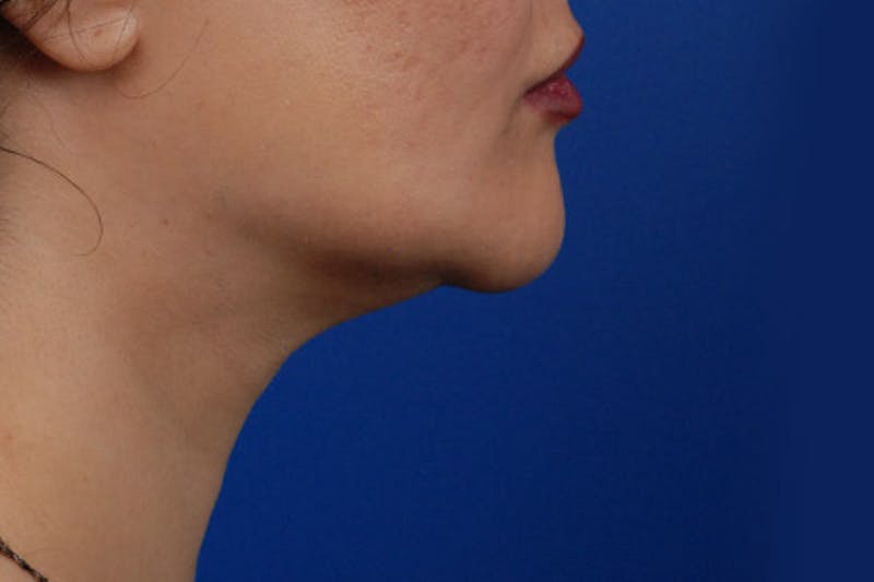 Kybella Before & After Gallery - Patient 12973941 - Image 8
