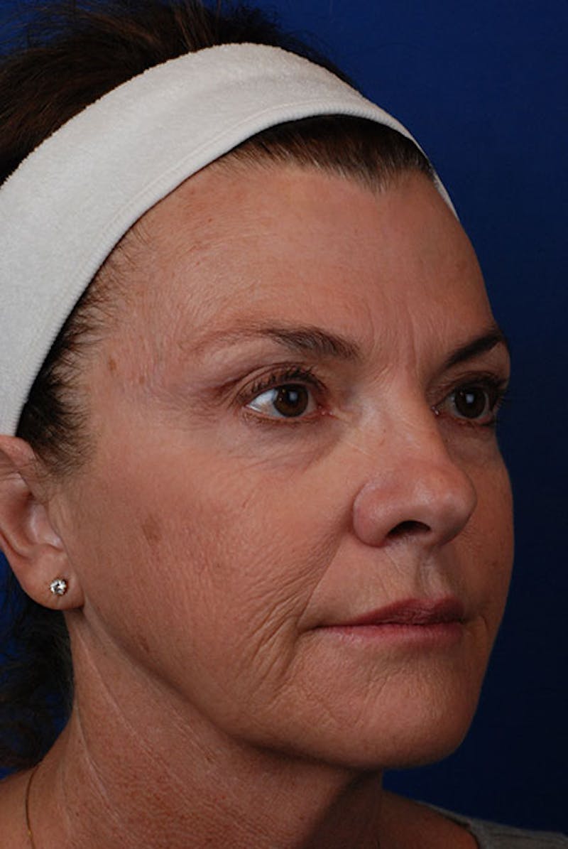 Laser Skin Resurfacing Before & After Gallery - Patient 12973942 - Image 3