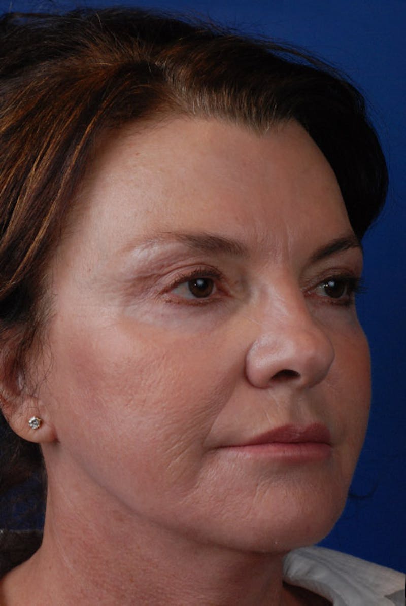 Laser Skin Resurfacing Before & After Gallery - Patient 12973942 - Image 4