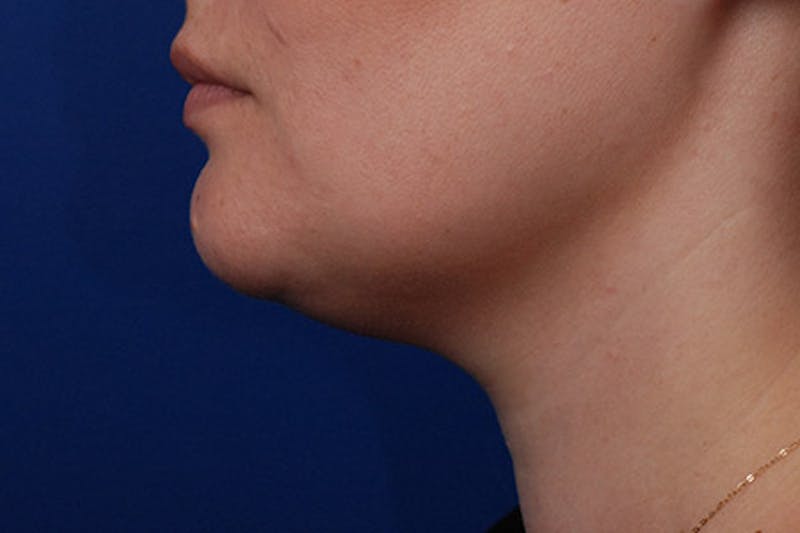 Kybella Before & After Gallery - Patient 12973943 - Image 1