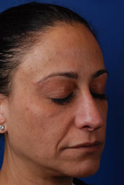 Microneedling Before & After Gallery - Patient 12973956 - Image 1