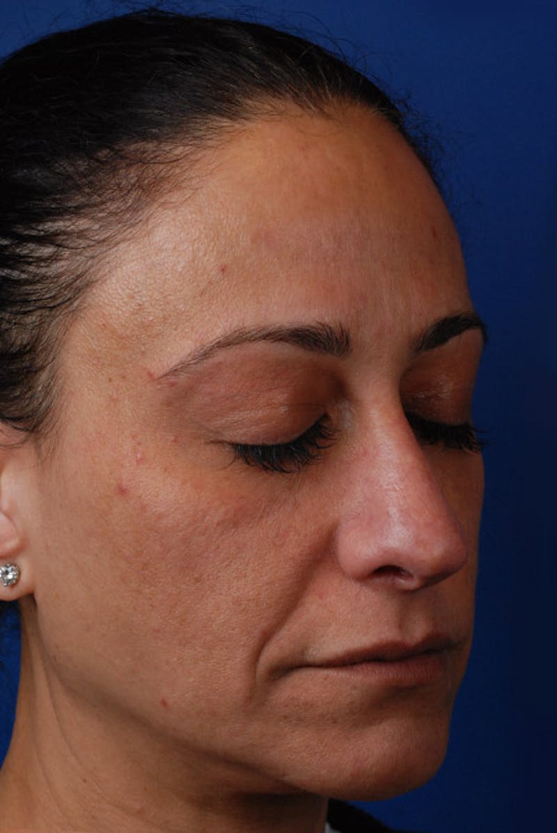 Microneedling Before & After Gallery - Patient 12973956 - Image 1