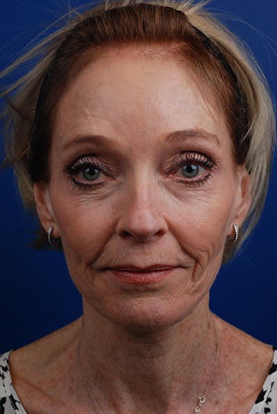 Laser Skin Resurfacing Before & After Gallery - Patient 12973957 - Image 1