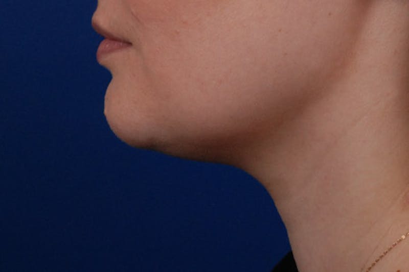 Kybella Before & After Gallery - Patient 12973943 - Image 2