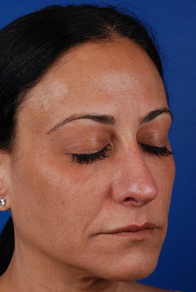 Microneedling Before & After Gallery - Patient 12973956 - Image 2