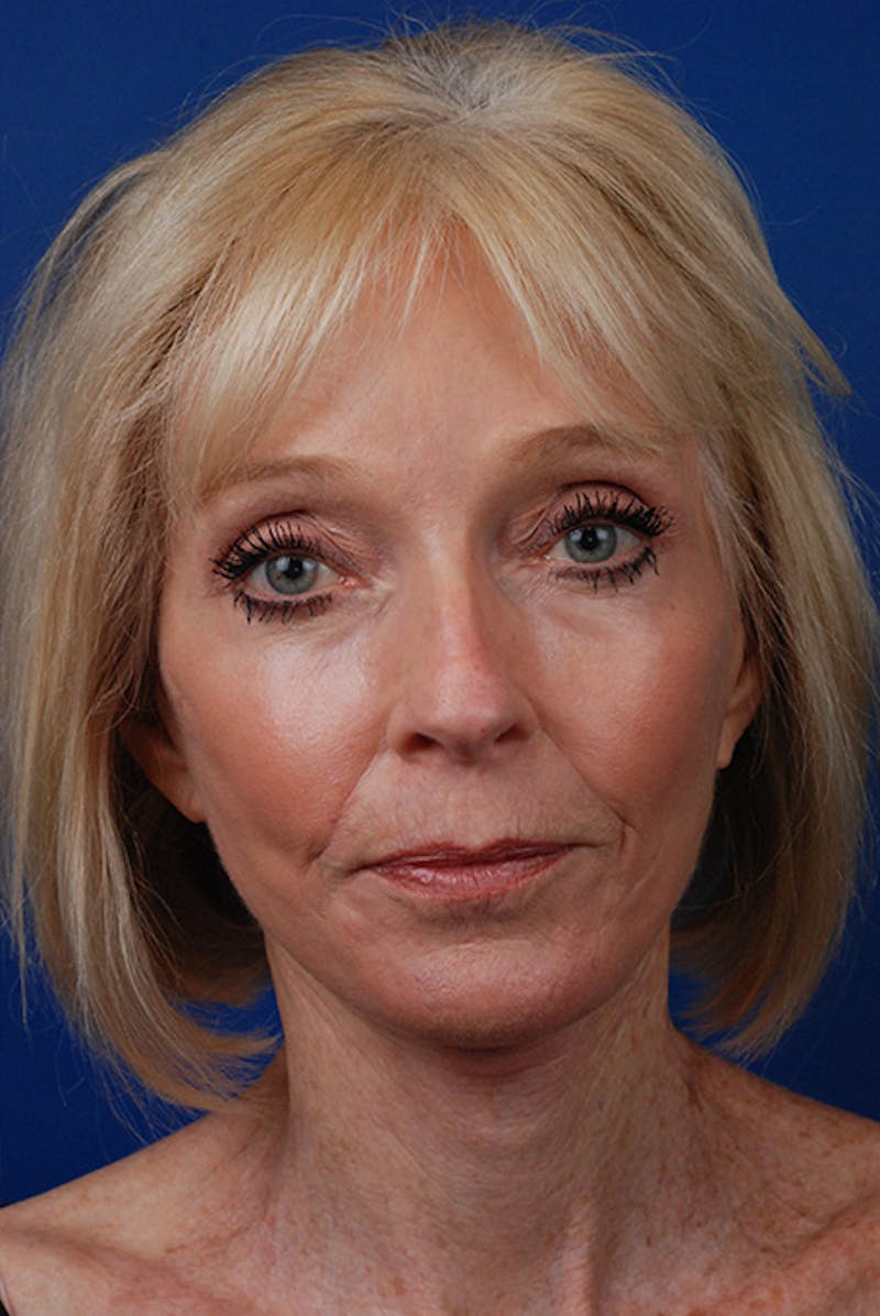 Laser Skin Resurfacing Before & After Gallery - Patient 12973957 - Image 2