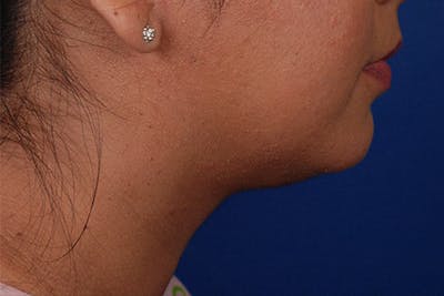 Kybella Before & After Gallery - Patient 12973958 - Image 1