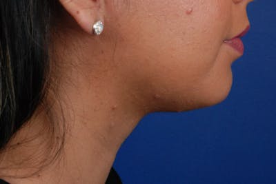 Kybella Before & After Gallery - Patient 12973958 - Image 2