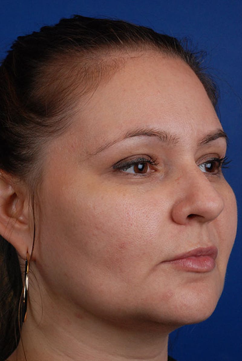 Kybella Before & After Gallery - Patient 12973965 - Image 2