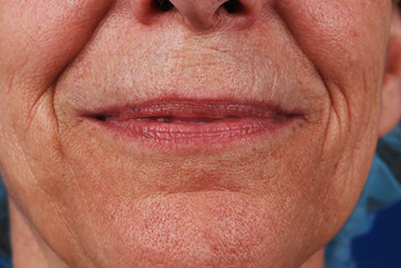 Laser Skin Resurfacing Before & After Gallery - Patient 12973962 - Image 1