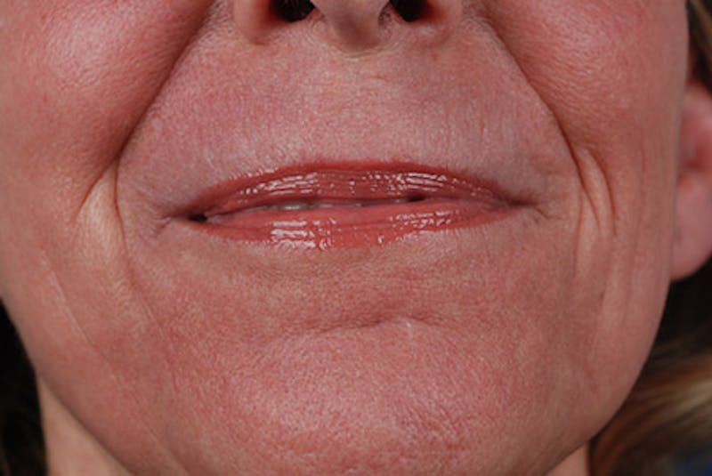 Laser Skin Resurfacing Before & After Gallery - Patient 12973962 - Image 2