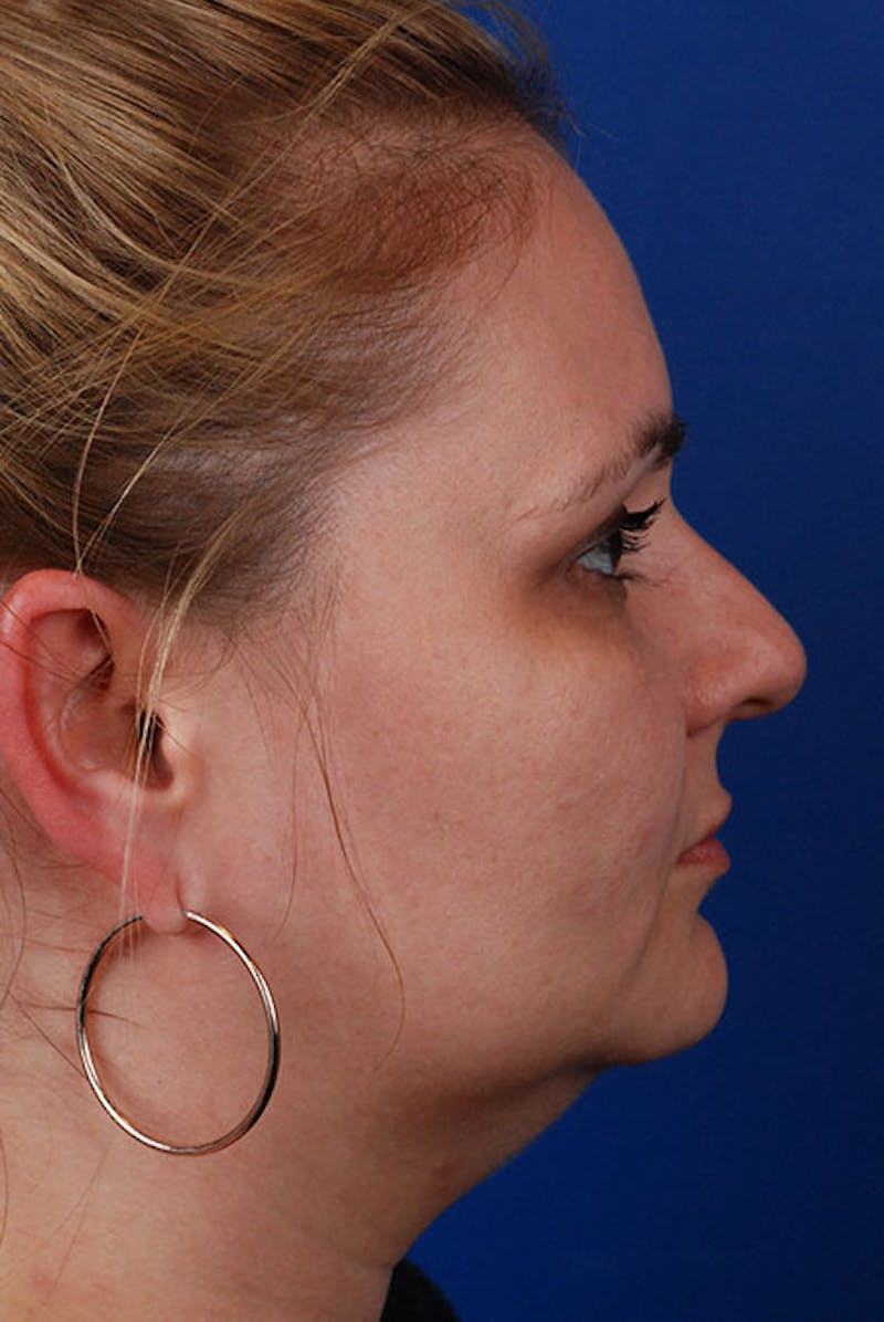 Kybella Before & After Gallery - Patient 12973965 - Image 5