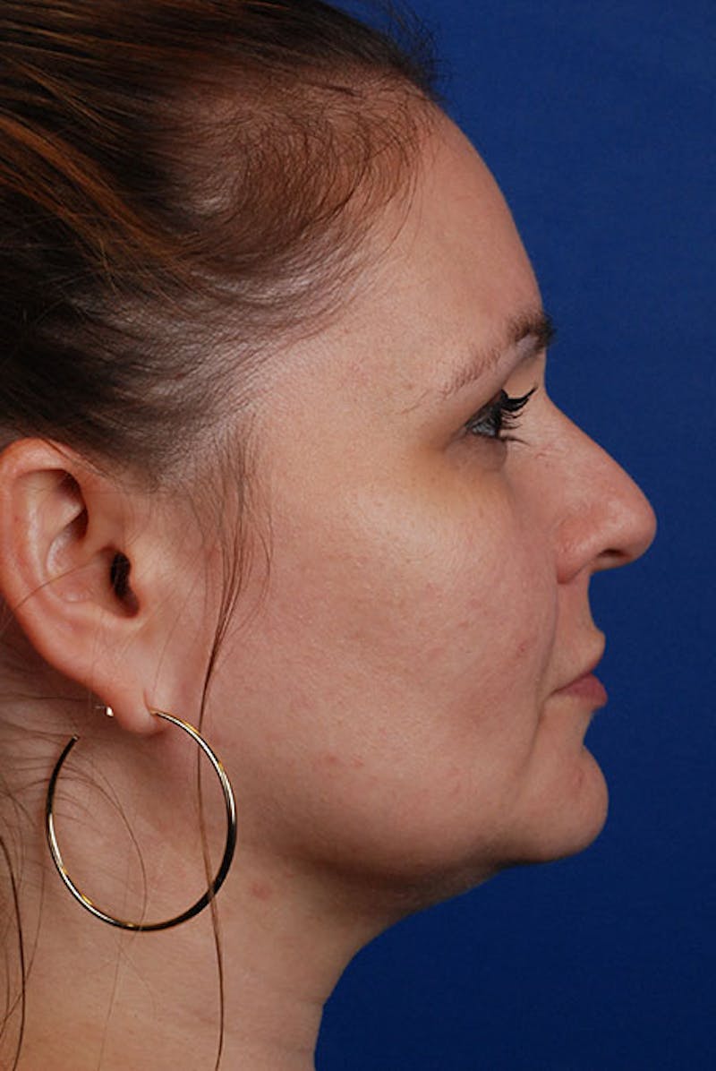 Kybella Before & After Gallery - Patient 12973965 - Image 6