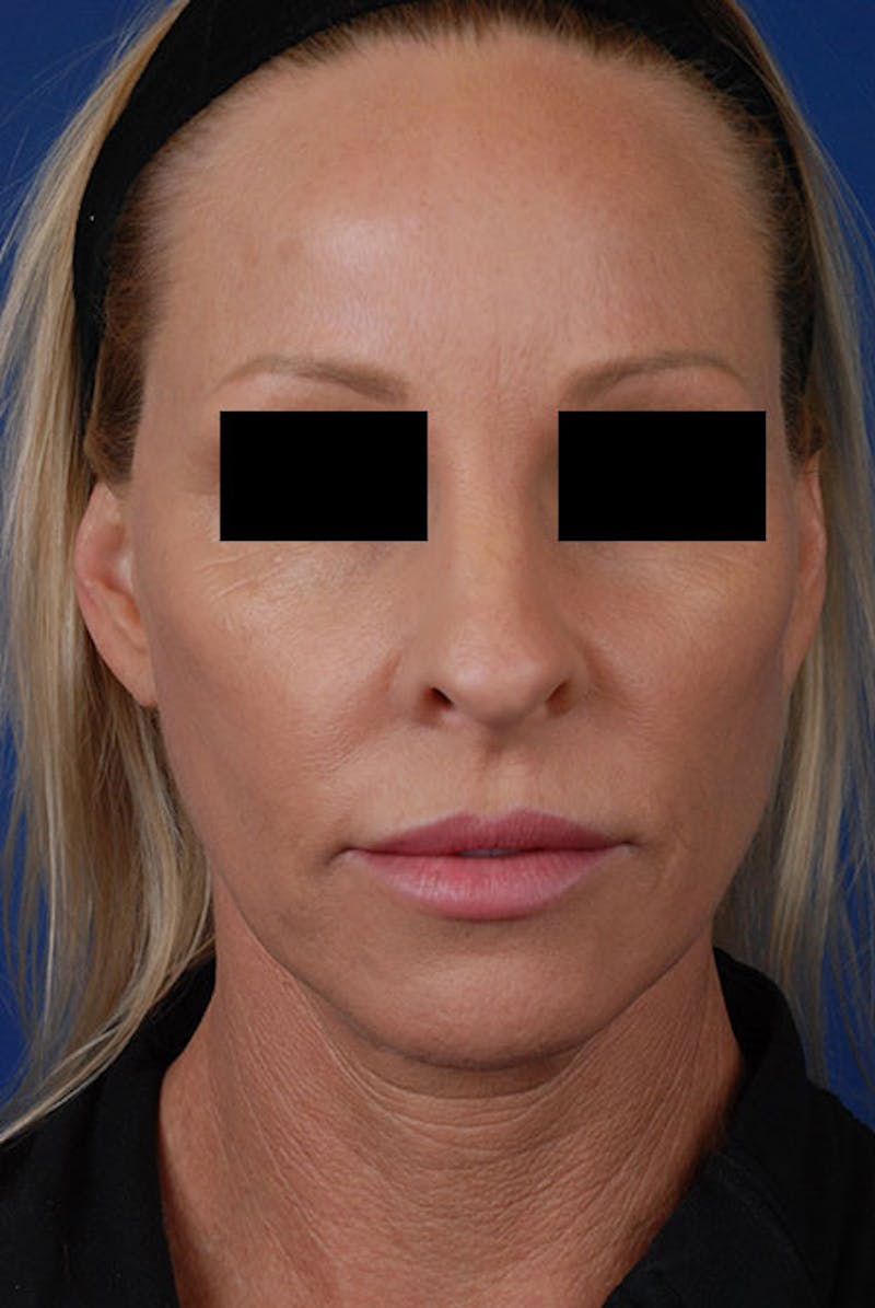 Sculptra Before & After Gallery - Patient 12973966 - Image 2