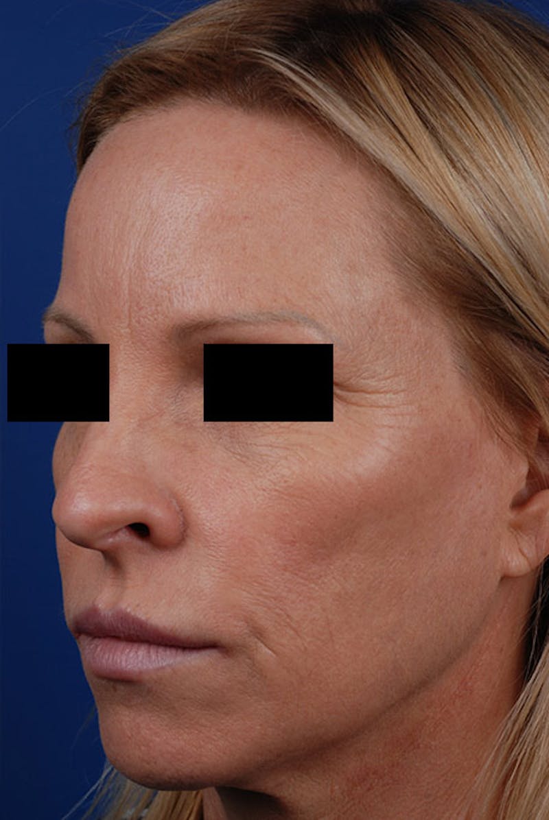 Sculptra Before & After Gallery - Patient 12973966 - Image 3