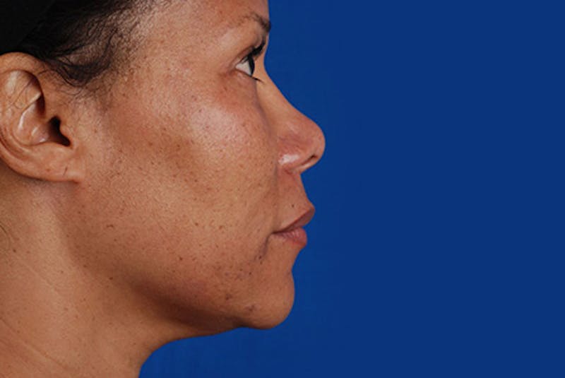 Ultherapy Before & After Gallery - Patient 12973971 - Image 1