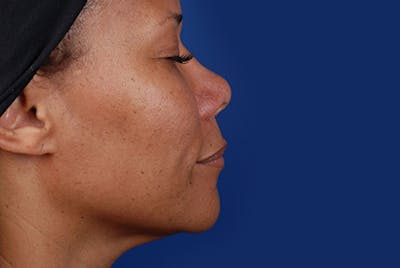 Ultherapy Before & After Gallery - Patient 12973971 - Image 2