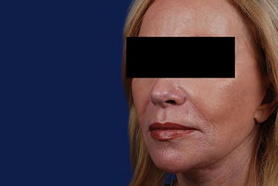 Ultherapy Before & After Gallery - Patient 12973974 - Image 1