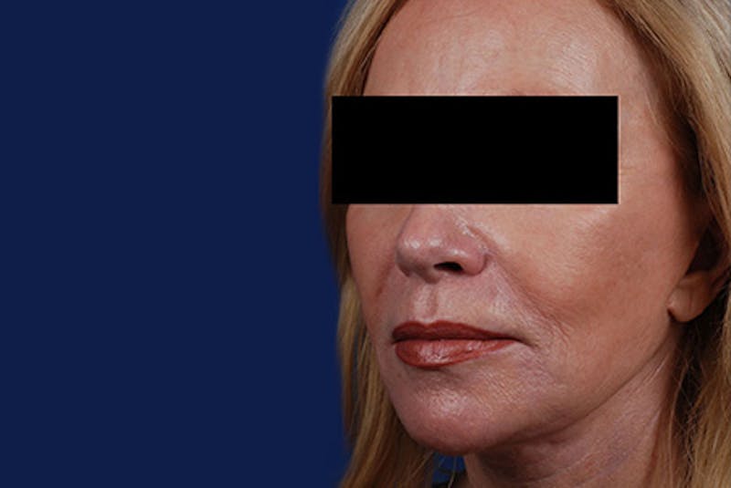 Ultherapy Gallery - Patient 12973974 - Image 1