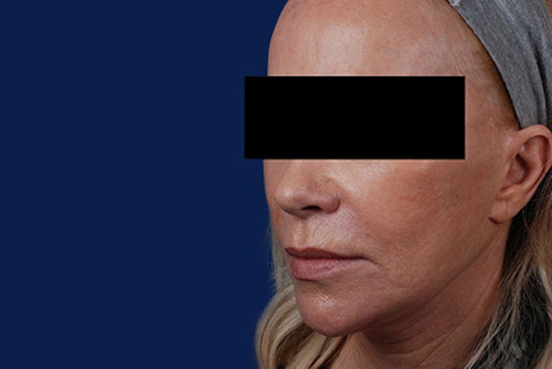 Ultherapy Gallery - Patient 12973974 - Image 2