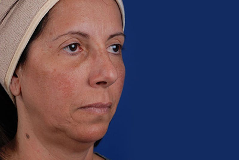 Ultherapy Before & After Gallery - Patient 12973976 - Image 1