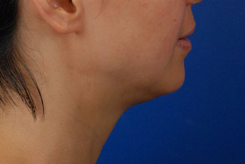 Ultherapy Gallery - Patient 12973977 - Image 1