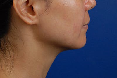 Ultherapy Before & After Gallery - Patient 12973977 - Image 2