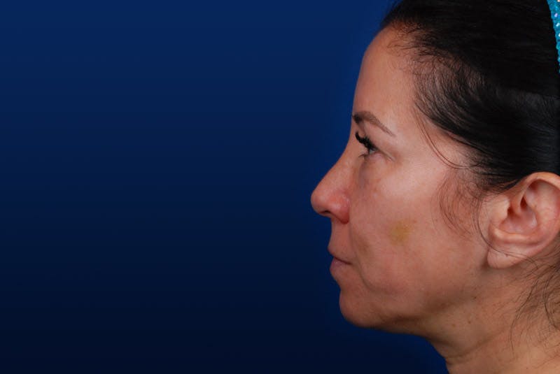 Ultherapy Before & After Gallery - Patient 12973978 - Image 1