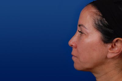 Ultherapy Before & After Gallery - Patient 12973978 - Image 2