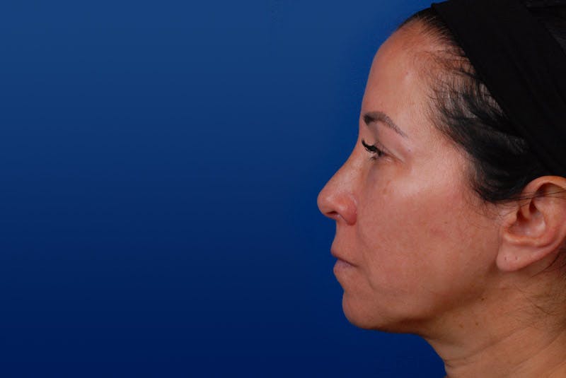 Ultherapy Gallery - Patient 12973978 - Image 2
