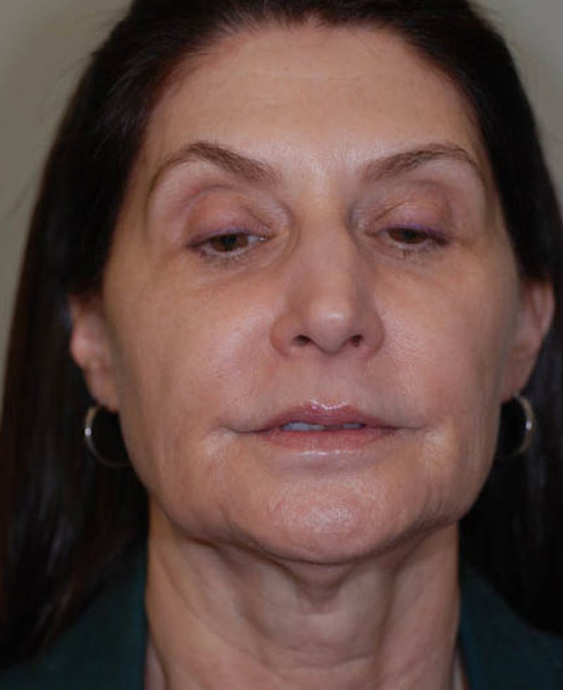 Facelift Before & After Gallery - Patient 12973985 - Image 1