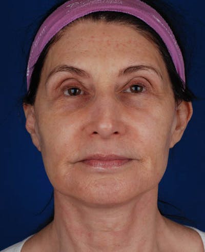 Facelift Before & After Gallery - Patient 12973985 - Image 2