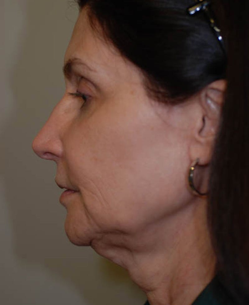 Facelift Before & After Gallery - Patient 12973985 - Image 3