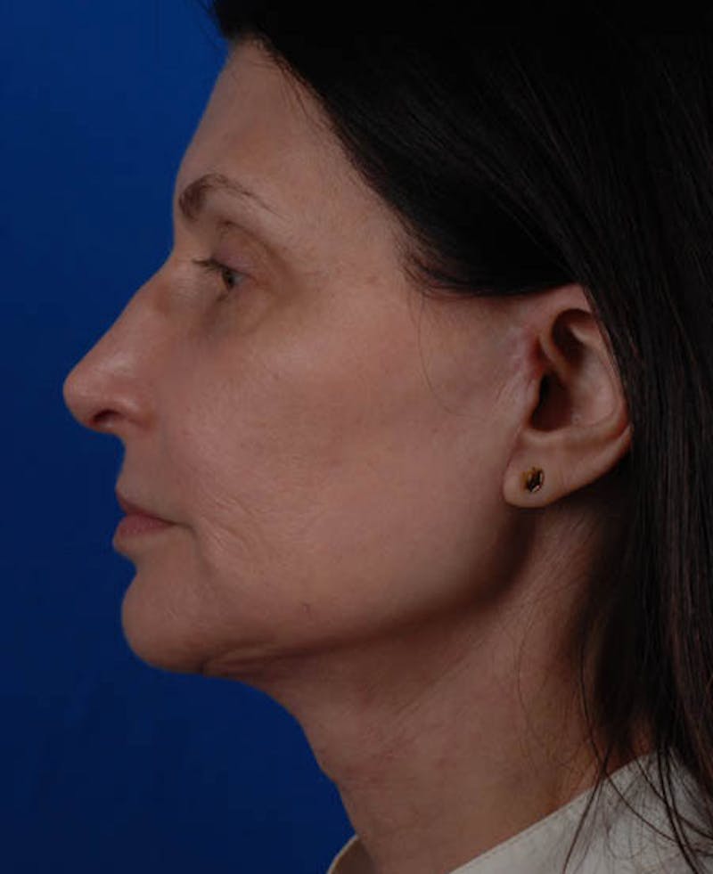 Facelift Before & After Gallery - Patient 12973985 - Image 4