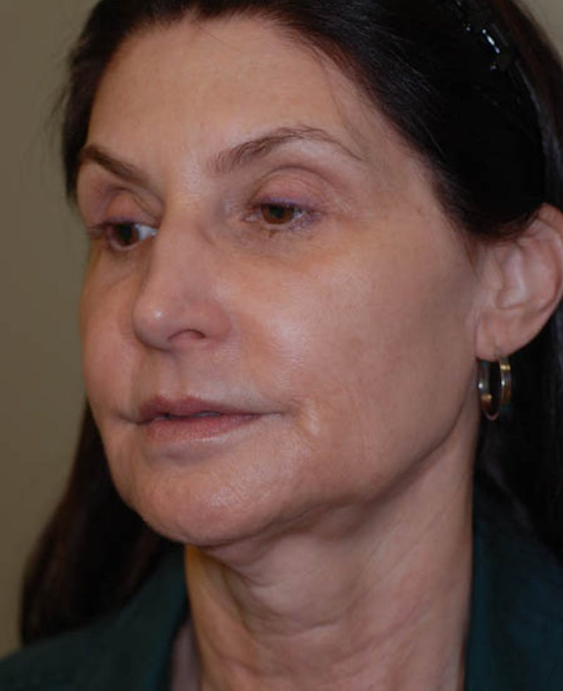 Facelift Before & After Gallery - Patient 12973985 - Image 5