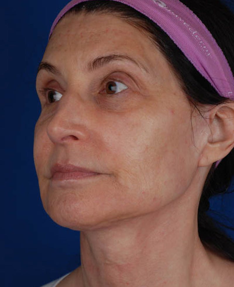 Facelift Before & After Gallery - Patient 12973985 - Image 6