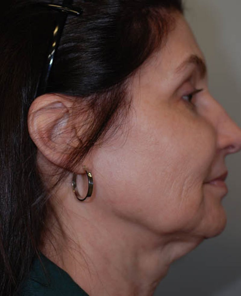 Facelift Before & After Gallery - Patient 12973985 - Image 7