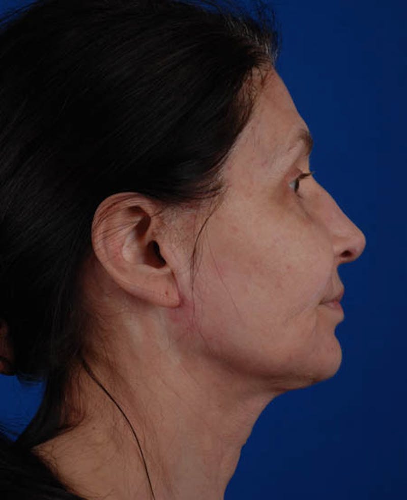 Facelift Before & After Gallery - Patient 12973985 - Image 8
