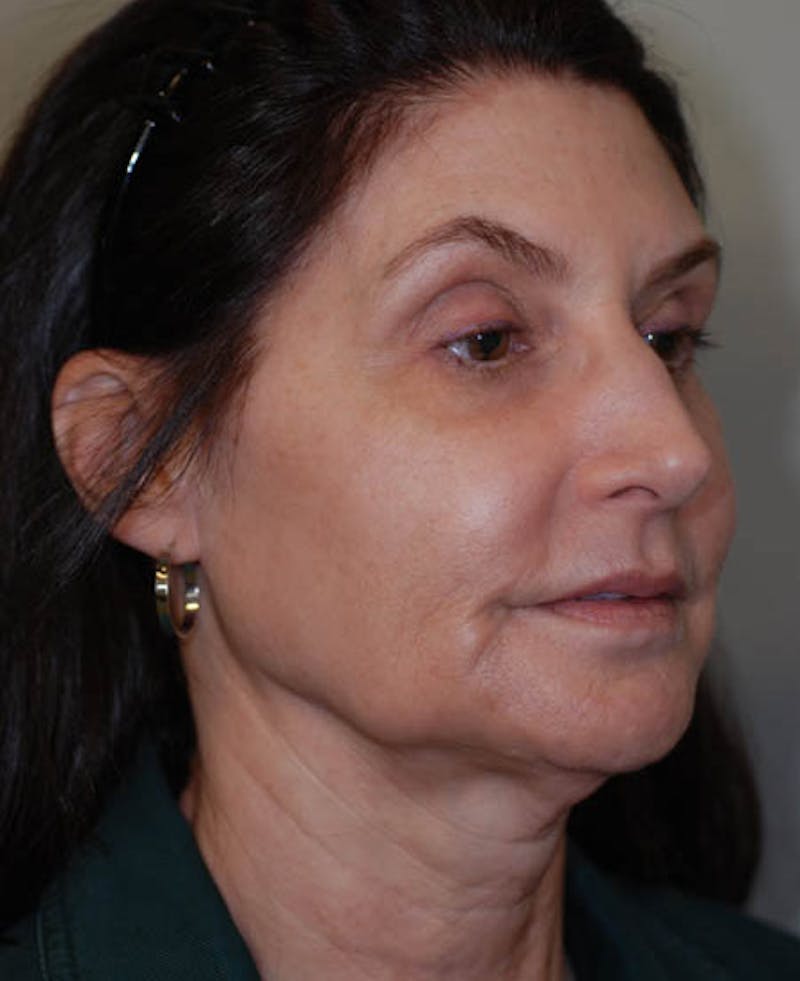 Facelift Before & After Gallery - Patient 12973985 - Image 9