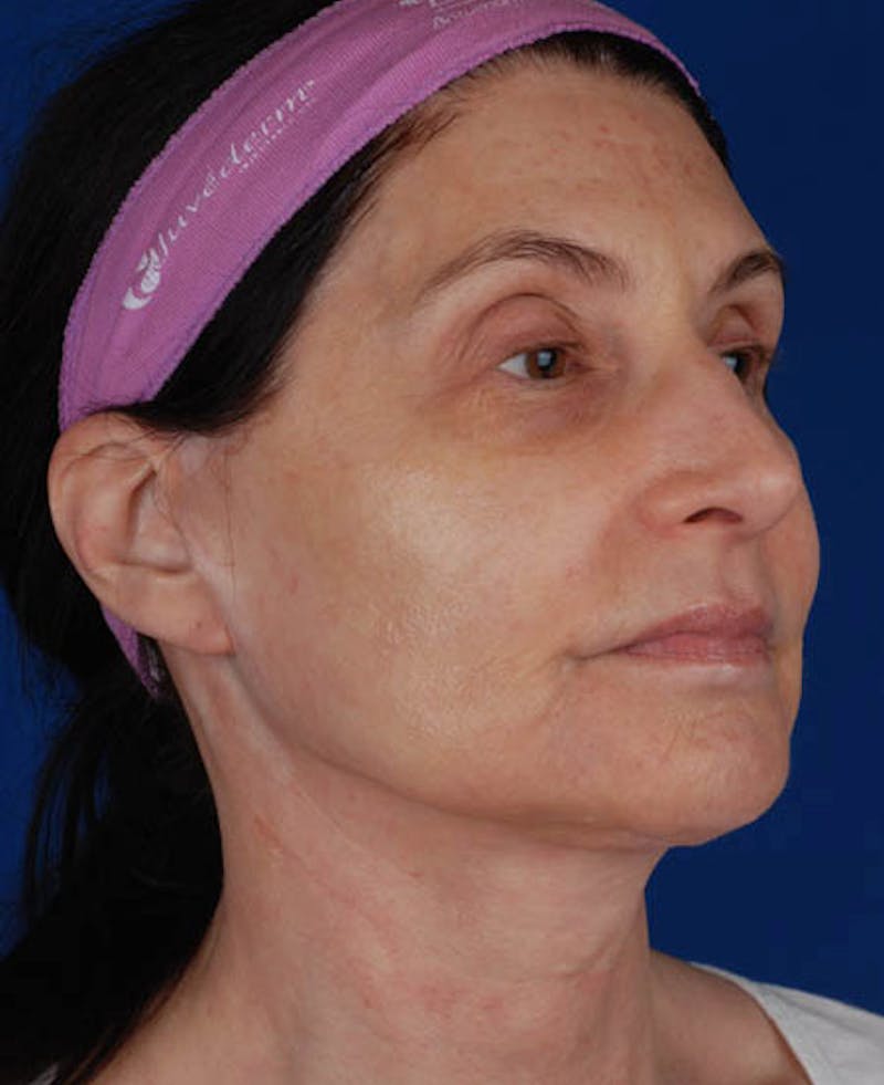 Facelift Before & After Gallery - Patient 12973985 - Image 10